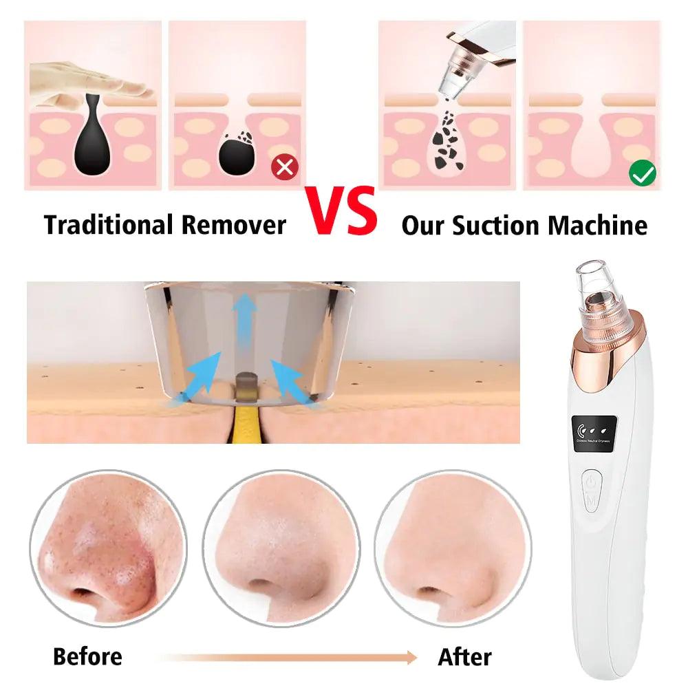 Electric Blackhead Remover - Omatic Health