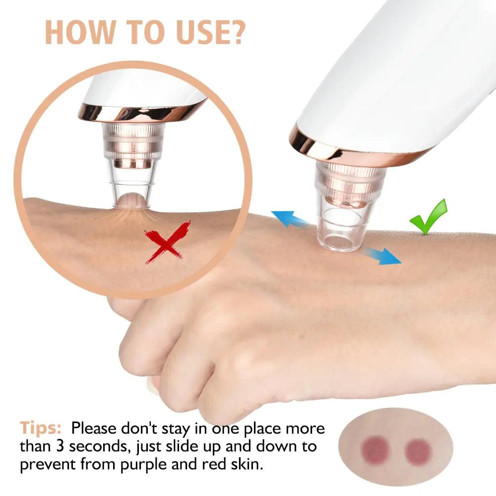 Electric Blackhead Remover - Omatic Health